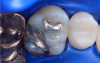 Fig 3. Occlusal view of the tooth before the restoration.