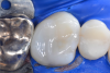 Fig 6. Finished Class II restoration using matrix system, flowable composite, and bulk-fill composite.