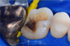 Fig 7. Cavity preparation.