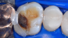 Fig 9. Clear matrix placed on tooth.