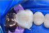 Fig 16. The excess composite after both the flowable composite and regular paste bulk-fill composite were injected into restoration.