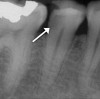 Fig 1. Obtaining a pretreatment pulpal and periradicular diagnosis prior to restorative treatment allows the clinician to properly treat the dental pulp if exposed during caries removal. Here, radiographic evidence of decay is shown on tooth No. 29 (arrow).