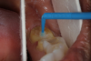 Fig 2. Isolation for posterior mandibular crowns with use of cardboard cheek retractors.