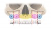 Fig 4. The zones of the maxilla.
