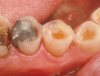 Fig 13. Wear of occlusal surface adjacent to amalgam restoration, leaving dentin exposed and susceptible to continued erosion and attrition.