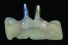 Fig 12. The provisional prosthesis is shown after removal from the patient’s mouth. <br>