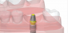 Fig 2. Illustration of a memory metal nickel-titanium abutment system.