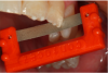 Figure 10. Diamond strips used for interproximal finishing can also be used to clear the contact when teeth are accidentally bonded together.