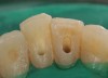 Figure 13  Access holes after endodontic treatment.