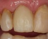 Figure 22  All-composite crown constructed chairside and bonded to adjacent teeth on terminally ill patient.