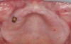 Figure 13  In Case 2, a mini implant in the maxillary right first bicuspid position served as a retentive anchor for a full denture.