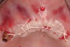 Figure 17  Tension-free primary closure achieved with monofilament PTFE sutures.