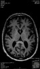 Fig 1. Alzheimer’s disease and Huntington’s disease result in widespread loss of neurons, as shown in this magnetic resonance image (MRI) of the brain of an elderly patient (top arrow: head of caudate nucleus; bottom arrow: putamen).