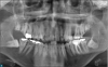 Fig 1. This panoramic view shows a challenging case with impacted third molars, several failing restorations, multiple non-restorable teeth, rampant decay, and periodontal disease.