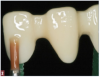 Fig 2. The earliest versions of zirconia were used as frameworks on which more esthetic, lower-strength layering ceramic was placed.