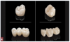 Fig 4. Monolithic zirconia restorations.
