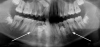 Fig 5. Supernumerary teeth in mandible.