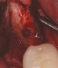Fig 5. Reentry at 7 months demonstrated full ridge width preservation and minimal residual graft material.