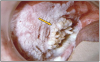 Figure 8 – Verrucous carcinoma. Image provided by: Dr. JE Bouquot