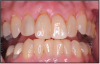 Figure 4 – Examples of gingival recession; exposed root surfaces are susceptible to dentinal hypersensitivity. Image courtesy of Jeffrey C. Hoos, DMD