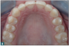 Fig 4. Normal, healthy arch width: approximately 36 mm from first molar to first molar at the gingival level.