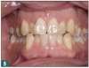 Fig 5. Slanted teeth are an indication of poor buccolingual inclination.