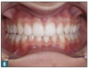 Fig 6. Proper buccolingual inclination of teeth.