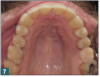 Fig 7. There should be no significant difference between the heights of the buccal and lingual cusps of the maxillary and mandibular premolars and molars.