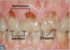 Fig 14. Abfractions, attrition, and chipping resulting from malocclusion.