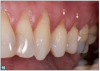 Fig 15. Teeth that align improperly can cause an abfraction.