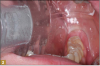 Fig 2. Decay was removed from the first molar, and air abrasion was performed.