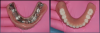 Fig 9. The removable overdenture was reinforced by a milled metal bar.