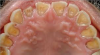 Fig 1. This image shows an advanced erosion case in the maxillary arch with extensive erosion of the enamel and dentin. There is also chipping, fracturing, and yellowing. Exposure of the teeth to gastric contents, such as that found in gastrointestinal reflux disease or purging as found in some eating disorders, are two possible sources of acid erosion leading to similar clinical findings.
