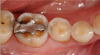 Fig 3. The amalgam restoration in the molar appears to be floating above the tooth surface.