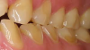 Fig 4. Buccal view of teeth with dental erosion exposing underlying dentin.