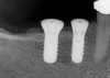 (28.) Postoperative periapical radiograph illustrating 2D implant positions.