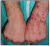 Figure 2 – Vasoconstriction and subsequent itching - Photo courtesy of Sheriff’s Department, Multnomah County, Oregon; United States Department of Justice, Meth Awareness Program