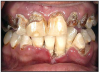 Figure 6 – Rampant Caries - Photo with permission from Clinton Substance Abuse Council