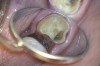 Fig 15. Final crown preparation. Note inflamed gingival tissues.