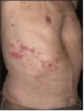 Figure 6 – Herpes Zoster lesions