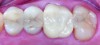 Fig 12. The new single-unit restoration was milled in-office from full zirconia and delivered to the patient within a single appointment. The fit was excellent, and the patient and clinician were both pleased with the final outcome.