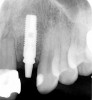 Figure 2  Identification of sufficient inter-radicular space: The radiographic representation of inter-radicular space (Fig 2) reveals abundant space for a single-tooth implant; at the alveolar crest, > 6 mm of interproximal space is available for placement of a 4-mm implant without encroaching on bone and periodontal ligament at the adjacent teeth. The 5-year-follow-up radiograph (Fig 3) reveals the interproximal maintenance of bone at this implant/abutment interface and adjacent teeth, in part due to proper planning and implant placement.
