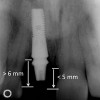 Figure 4  Characterization of the interproximal bone and tooth contacts: A periapical radiograph assists in measuring the distance from bone crest to the adjacent tooth contact points for missing tooth No. 8. The mesial bone crest to the adjacent tooth contact distance is < 5 mm, while the distal bone crest to adjacent tooth contact distance is > 6 mm (Fig 4). One-year following implant placement, conservation of these dimensions is revealed (Fig 5). The clinical photograph (Fig 6) of the lateral incisor adjacent to tooth No. 8 implant crown demonstrates that the absence of distal interproximal (papilla) fill related to the observed bone crest to contact distance exceeds 6 mm.