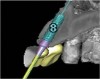Figure 19    Volumetric characterization of the residual alveolar ridge using CBCT: Fig 17 The coronal section of the maxilla reveals the cortical structure of the alveolar ridge associated with the missing right central incisor at the mid-root level. The buccal plate is identifiable and is characterized by little resorption. Fig 18  The saggital section of the maxillary alveolar ridge is displayed in relationship to the planned contour of the eventual implant crown. Fig 19 Importing DICOM files into planning software permits evaluation of the implant, abutment, and crown relationships with existing bone. These images readily characterize both the possible 6-mm mesiodistal width and the possible displacement of the implant 3-mm apical and 2-mm palatal to the planned gingival zenith.