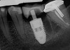 (4.) Radiograph showing immediate implant of No. 19 with immediate restoration day of surgery.