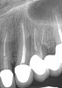 (8.) Case 2 initial radiograph of Nos. 12 through 14 with disunion of No. 12 crown to underlying root.