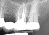 ( 9.) Case 2 initial radiograph of Nos. 12 through 14 with disunion of No. 12 crown to underlying root.