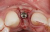 Fig 9. After 3 months of healing, the implant was uncovered. A crestal incision was made with a palatal bias and rolled to the labial side to increase the soft tissue to the facial aspect.