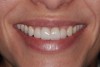 Fig 20. Extraoral view of final result; note the marked reduction of the gummy smile.
