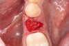 Fig 8. Delivery of the allograft material to the fresh bleeding socket.